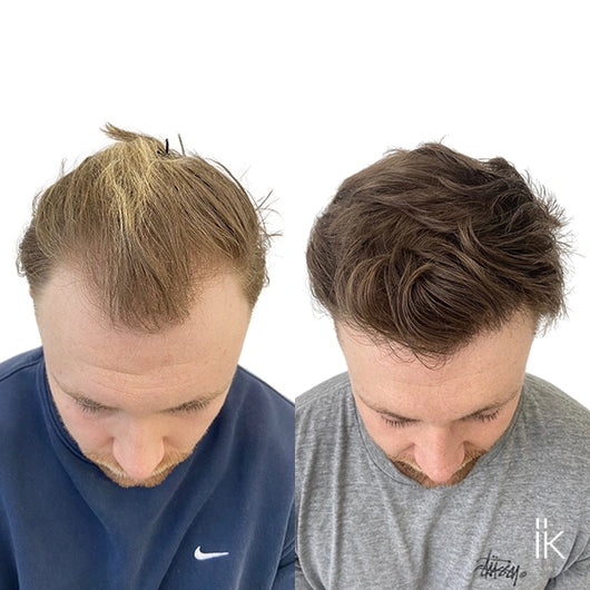 NuHair™ Minoxidil + Biotin Regrowth Formula