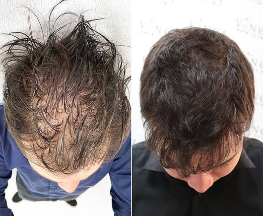NuHair™ Minoxidil + Biotin Regrowth Formula
